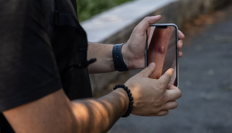 جدري القردة في لبنان... ما نجهله حتى الساعة!