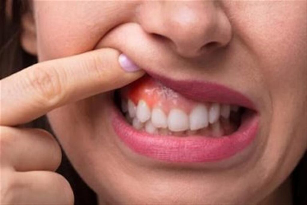 ما أسباب التهاب اللثة وكيفية الوقاية منها؟